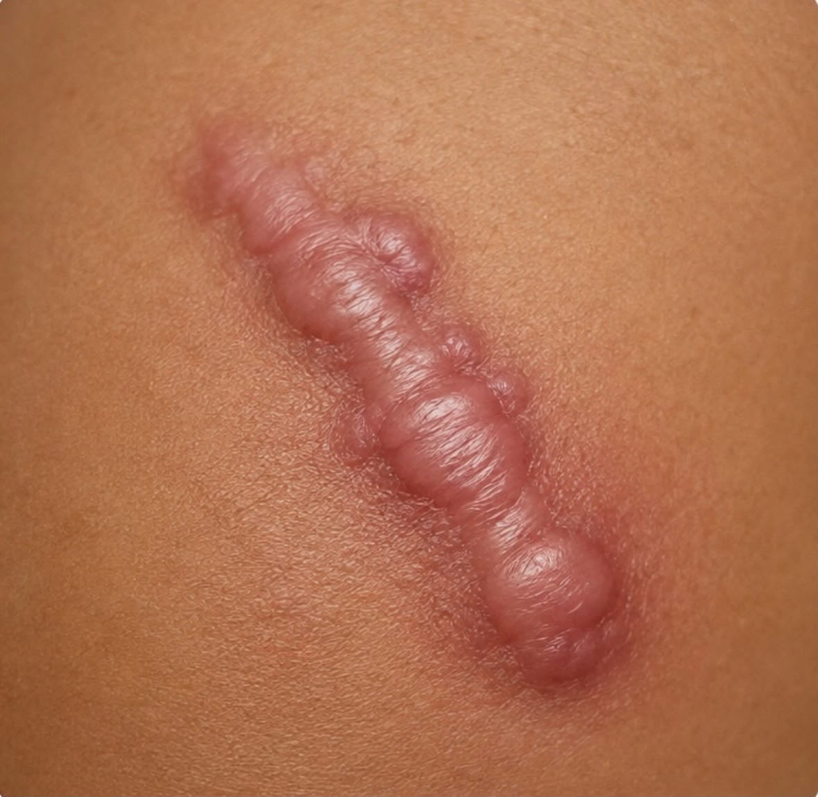 cicatrice hypertrophique
